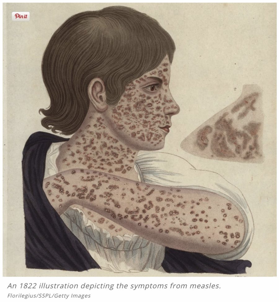 1822 illustration of measles, outlander contagion